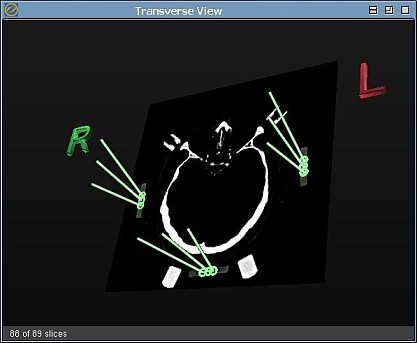 ogles localizer result